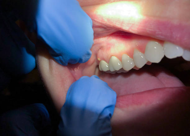 Best Broken or Cracked Tooth Emergency Dentist in Poplarville, MS